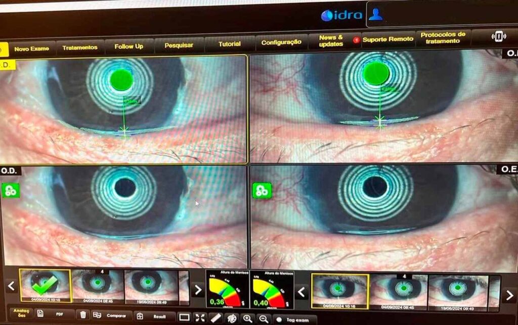 Credito-OFR-Divulgacao_-exame-IDRA_Easy-Resize.com_-1024x644 Sem toques nos olhos: exame inovador usa tecnologia para identificar Síndrome do Olho Seco