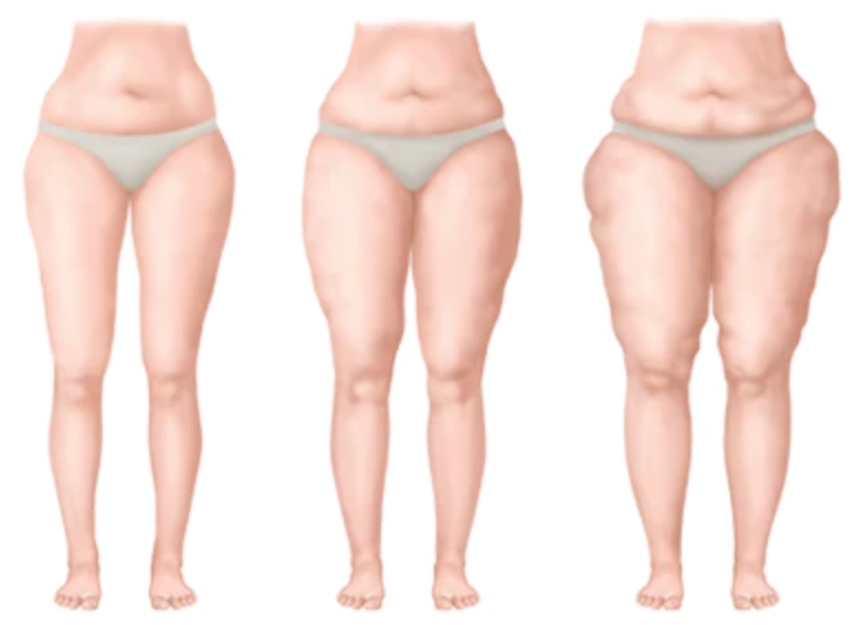 Lipedema-Divulgacao Lipedema: o que você precisa saber sobre essa doença