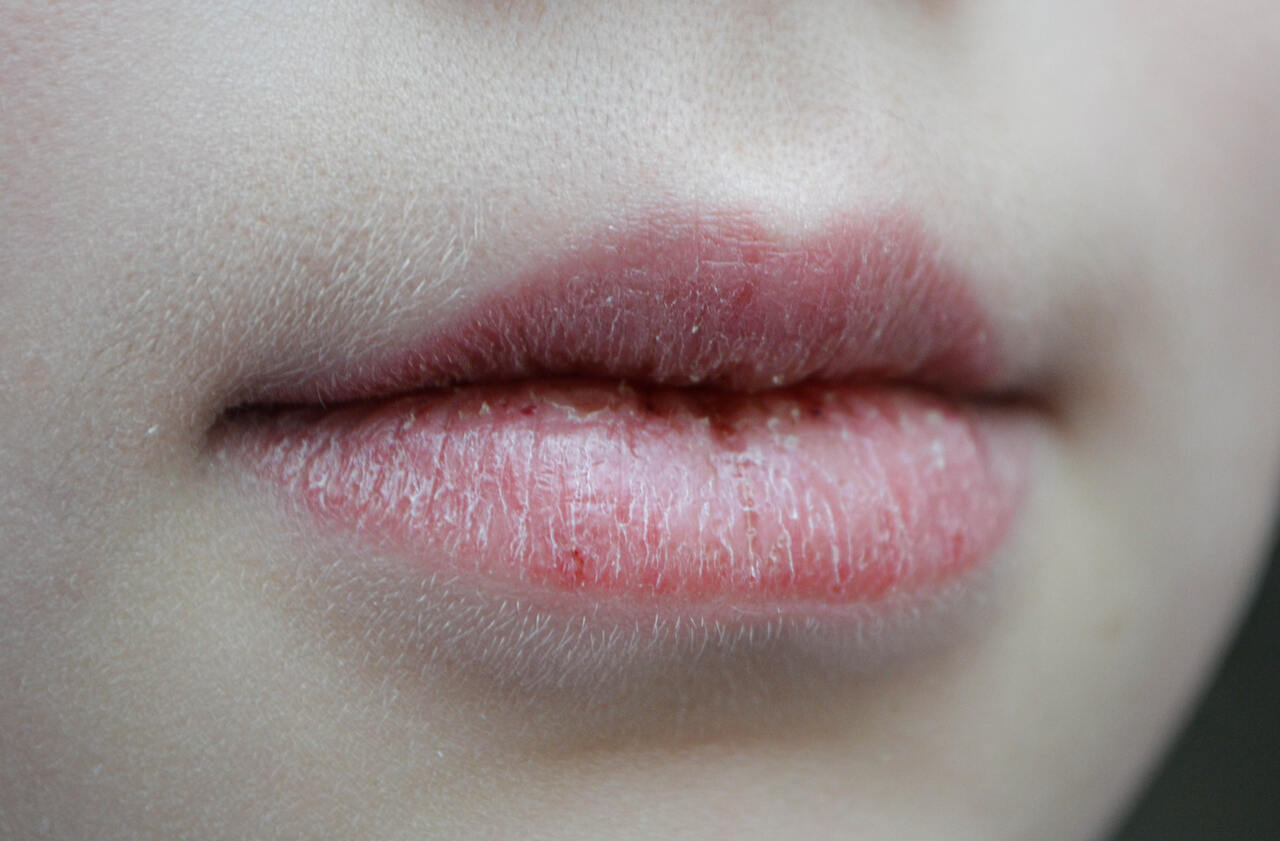 os-labios-secos-e-danificados_Easy-Resize.com_ Notícias